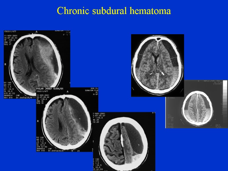 Chronic subdural hematoma